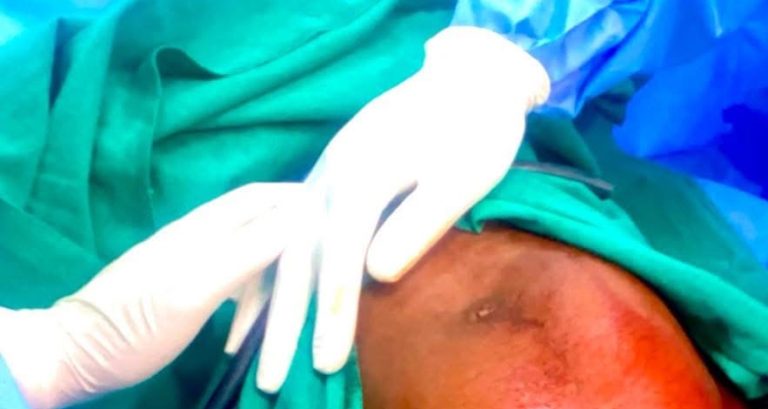 Heróis de bata branca no Marrere: residentes salvam mãe e bebé em cesariana de emergência