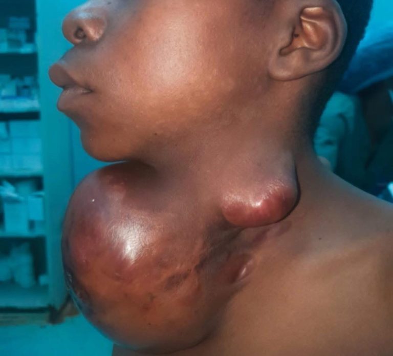 Tumor gigante cai em sala de operações: jovens médicos do HCN devolvem vida a adolescente de Meconta