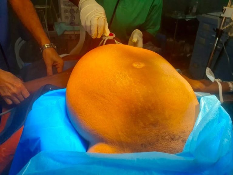 Tumor de 12 quilos retirado com sucesso: cirurgia de equipa devolve esperança a paciente em Nampula
